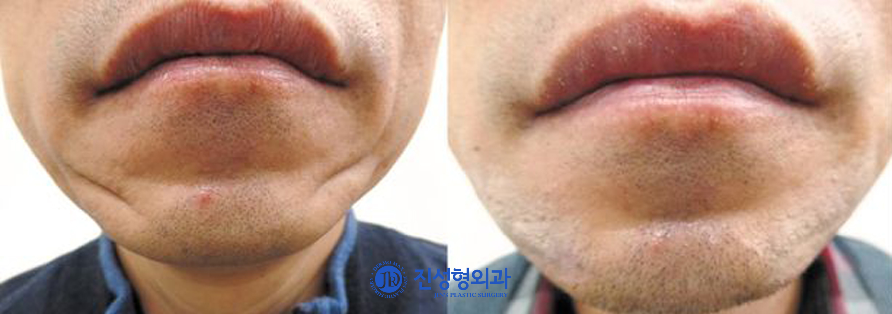 [조선일보] [메디컬 칼럼] 필러로도 못 없앤 깊은 주름, '자가진피재생술'로 해결
