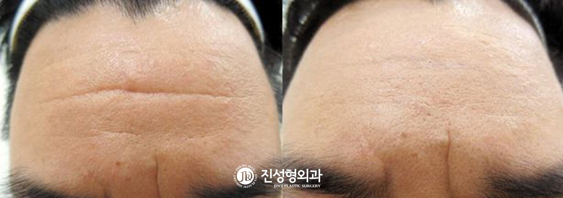 [조선일보] 보톡스도 소용없는 깊은 주름, 주사로 간단히 편다