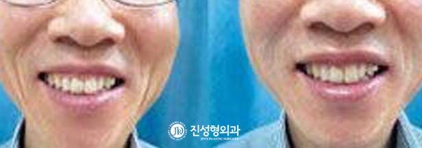 [조선일보] 깊은 팔자주름, 간단한 시술로 지울 수 있습니다