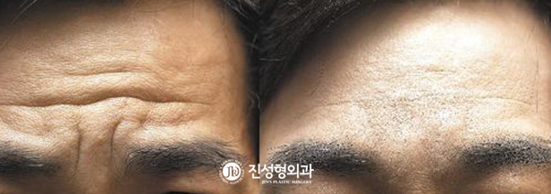 [조선일보] [메디컬 칼럼] 중장년층들, 주름 걱정 없이 당당하게 웃으세요