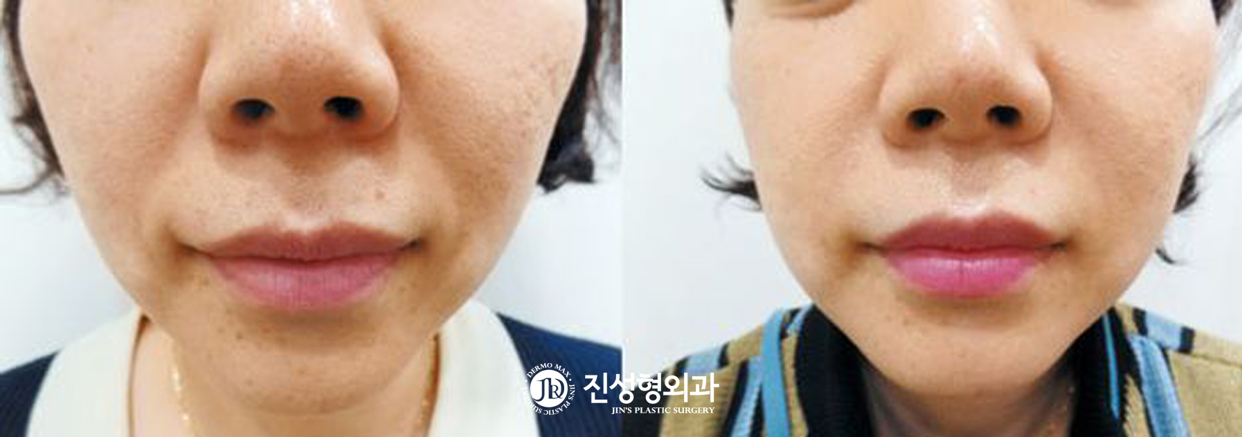 [조선일보] 쥬브젠 자가진피재생술로 입가 깊은 주름 펼수 있어