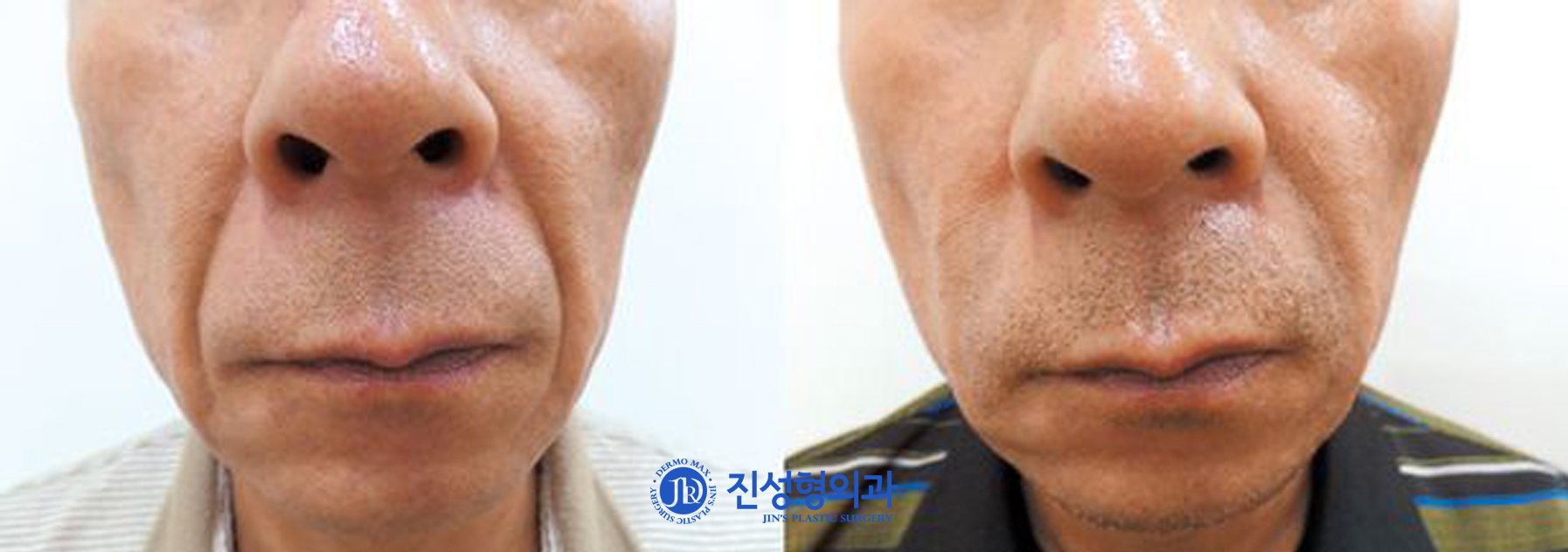 [조선일보] 깊게 팬 팔자 주름, 자가진피재생술로 새살 채운다