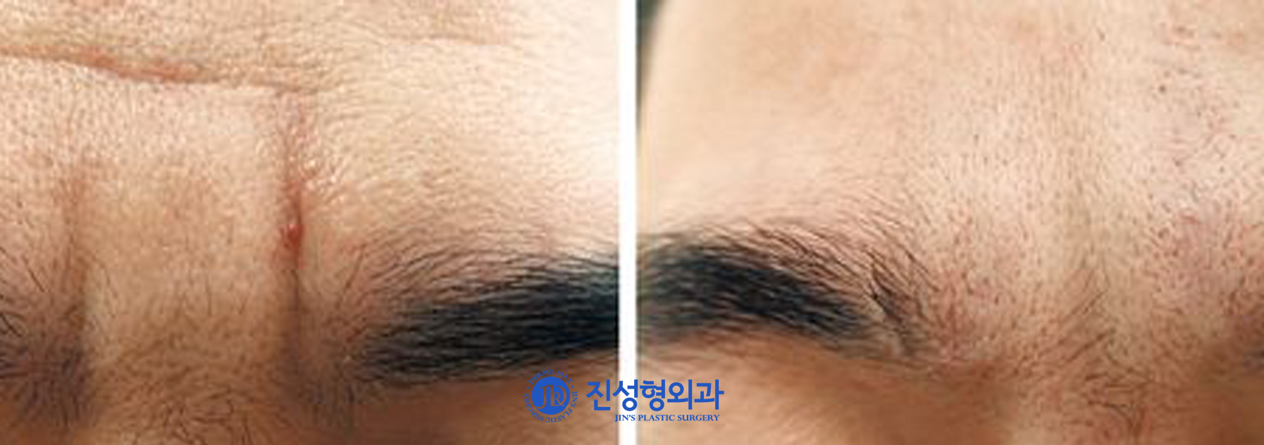 [조선일보] 깊은 미간 주름 주사로 간단히 편다