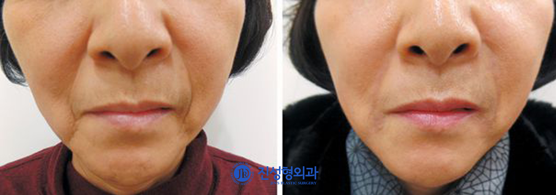 [조선일보] 필러 효과 없는 깊은 주름 '자가진피재생술'로 해결