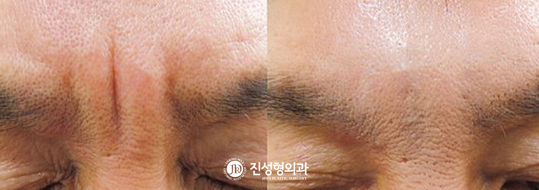 [조선일보] '화난' 미간 주름, 자가진피재생술로 '환하게' 편다