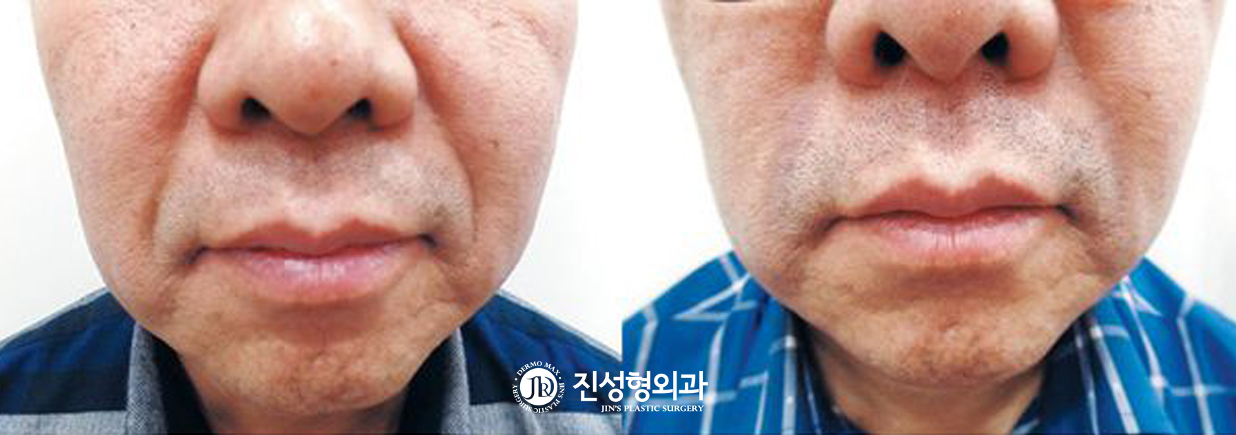 [조선일보] 필러로 해결 못한 깊은 주름… 새살 채워 간단히 편다