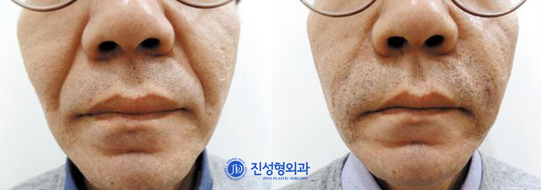 [조선일보] [메디컬 칼럼] 노화로 깊어진 주름, '자가진피재생술'로 편다