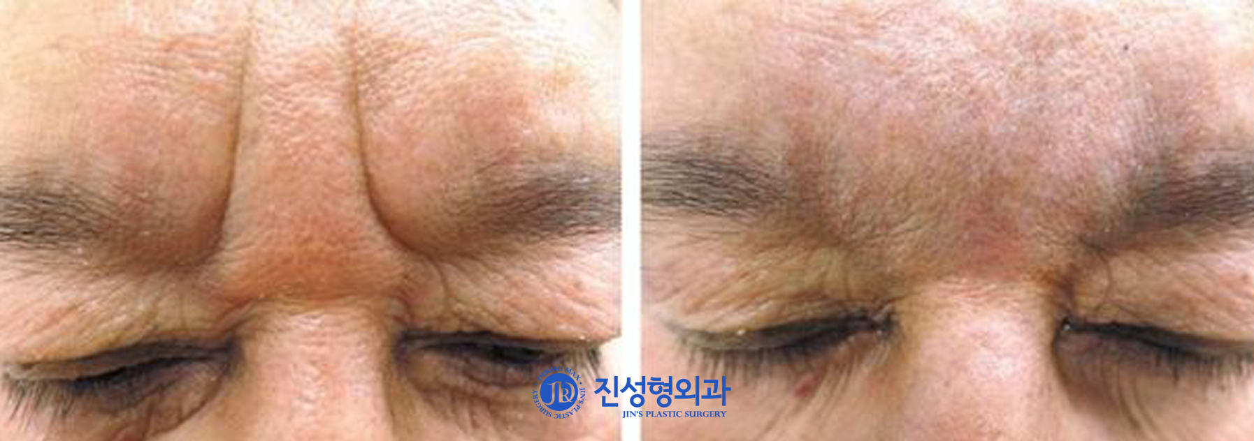 [조선일보] 점점 깊어지는 미간 주름 자가진피재생술로 쫙 펴자