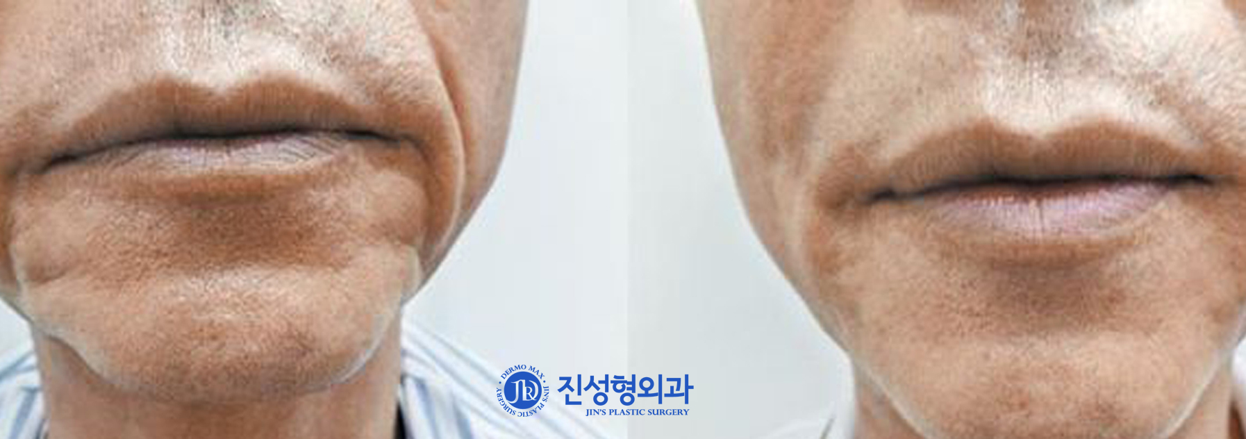 [조선일보] 입가에 깊게 패인 주름, 주사로 간단하게 편다