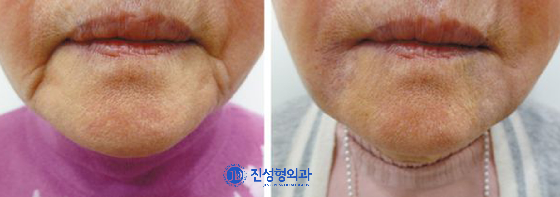 [조선일보] 노안 주범 마리오넷 주름 J자가진피재생술로 개선