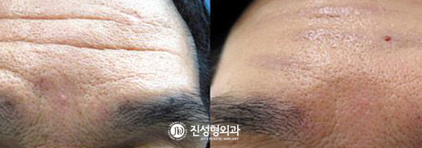 [조선일보] [메디컬 칼럼] 수술로도 해결 못 한 깊은 주름… '자가 진피 재생술'로 새살 돋게 해 활짝 편다