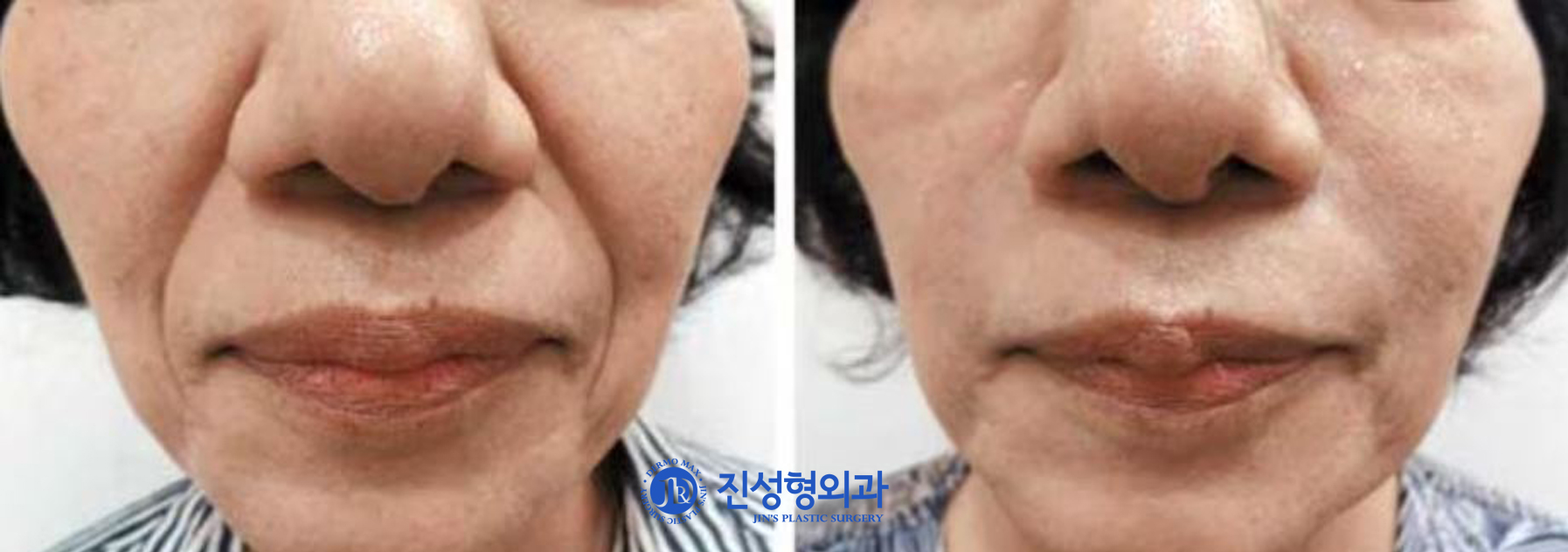 [조선일보] 신경 쓰이는 팔자·입가 주름… 제이자가진피재생술로 '쫙~'