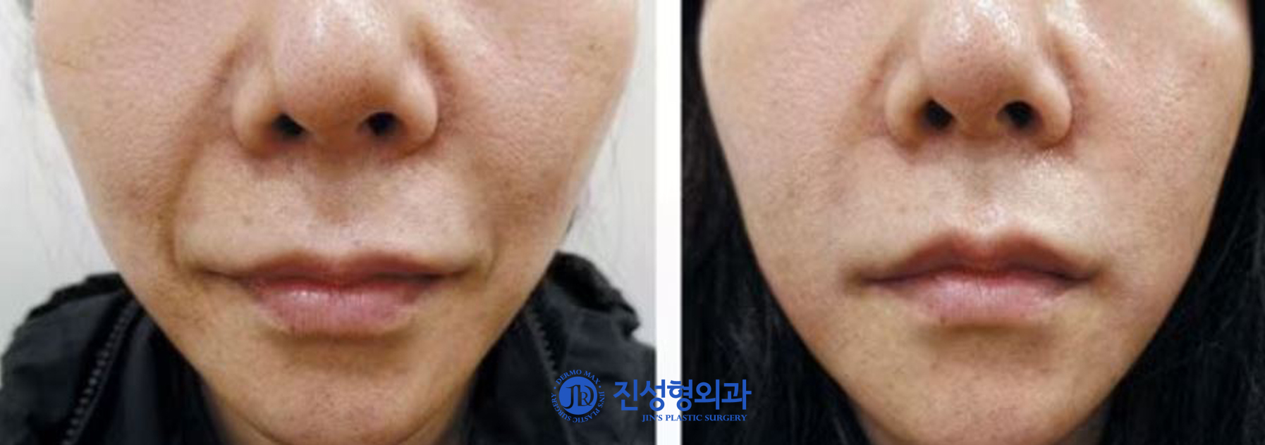 [조선일보] 필러나 보톡스 맞아도 주름 펴지지 않았다면?