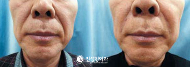 [조선일보] 진피층에 이산화탄소가스·히알루론산 주입 콜라겐 생성 도와 깊은 주름까지 펴 준다