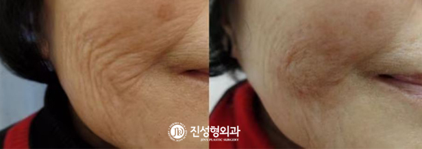 [조선일보] [메디컬 칼럼] 수술로도 못 펴는 깊은 주름, 주사로 간단히 해결