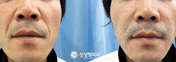 [조선일보] [메디컬 칼럼] 필러·수술로도 못 펴는 깊은 주름, 자가진피재생술로 단시간에 해결