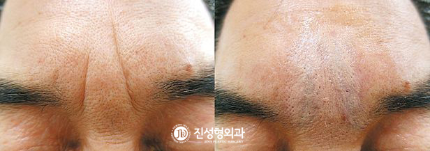 [조선일보] 진피층에 콜라젠… 깊은 미간주름, 자연스럽게 펴진다