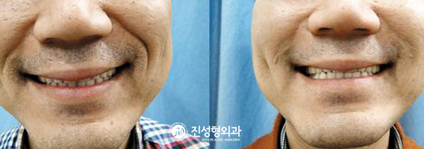 [조선일보] [메디컬 칼럼] 진피층에 새살 돋게 해 팔자주름 활짝… 치료기간도 짧아